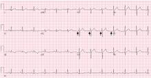 Figure 2. Electrocardiography 24 hours after presentation and after the patient’s musculoskeletal pain had been brought under control showed resolution of the delta waves (arrows) and normal PR intervals.