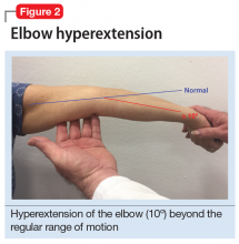 Elbow hyperextension image