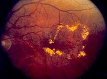 A photo of diabetic macular edema is shown