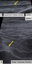 In ultrasonography, a trade-off exists between image resolution and penetration depth