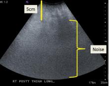 Ultrasonography of the posterior thigh in a patient with obesity