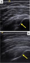 On ultrasonography, anisotropy causes a hypoechoic defect of the articular supraspinatus tendon fibers 