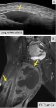 Musculoskeletal ultrasonography is inappropriate for evaluating large areas