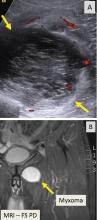 A deep, complex intramuscular soft-tissue mass seen on ultrasonography