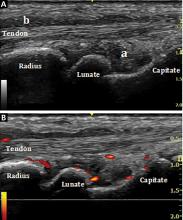 Musculoskeletal ultrasonography demonstrates wrist synovitis and extensor tendon tenosynovitis