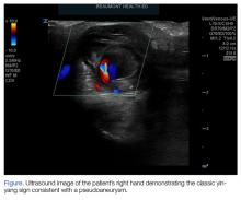 Figure. Ultrasound image of the patient’s right hand demonstrating the classic yin-yang sign consistent with a pseudoaneurysm.