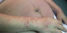 Erythematous papules and plaques on the upper limbs and in the lower abdominal striae, sparing the umbilical regio