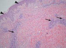 Histologic study of the abdominal plaque showed moderate superficial perivascular lymphohistiocytic infiltrate with eosinophils