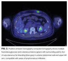 Positron emission tomography computed tomography shows multiple fluorodeoxyglucose-avid cutaneous lesions (green) with surrounding patchy foci of subcutaneous fat stranding (blue-grey) in anterior abdominal wall and upper left arm, compatible with areas o