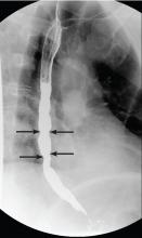 Barium esophagography showed tertiary contractions in the distal esophagu