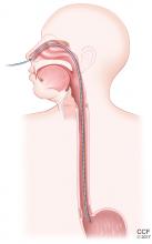 Esophageal manometry 