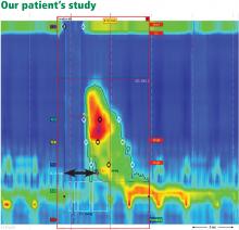 In our patient, esophageal manometry showed distal esophageal spasm and premature contraction, with a distal latency (black arrow) less than 4.5 seconds