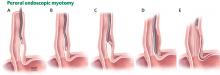 In peroral endoscopic myotomy, an experimental treatment for esophageal spasm, the endoscope is inserted into the space between the endothelium and muscle (A) and advanced to the distal esophagus (B or C) or the lower esophageal sphincter (D), where the m