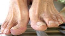 Blue-toe syndrome