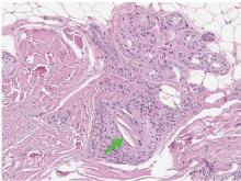 Biopsy of the cutaneous lesion on the toe revealed cholesterol clefts