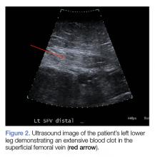 Rapid Deterioration and Death Caused by Bilateral Phlegmasia Cerulea ...