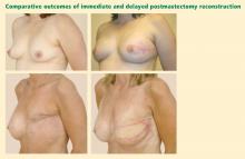 Figure 1. Top panels: A patient who underwent immediate postmastec­tomy reconstruction of the left breast. Bottom panels: A patient who under­went delayed postmastectomy recon­struction of the left breast. 