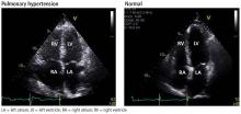 Echocardiographic views of a patient with pulmonary hypertension and a patient without