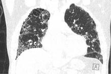 A patient with combined pulmonary fibrosis and emphysema