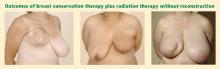 Figure 1. Patients who had breast conservation therapy (partial mastectomies) followed by radiation therapy without oncoplastic reconstruction. 