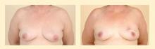 Figure 2. Preoperative (left) and postoperative (right) photos of a 58-year-old woman who underwent bilateral breast conservation therapy and reconstruction with local tissue rearrangement. 