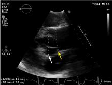 Figure 2. Echocardiographic image of an aneurysmal aortic root (white arrow) that tapers to normal dimensions at the sinotubular junction (yellow arrow) and ascending aorta.