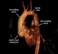 Figure 3. An aortic root aneurysm in a patient with Marfan syndrome using magnetic resonance angiography.