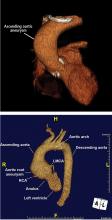 Figure 4. Top, 3D reconstruction of an ascending aortic aneurysm in a patient with a bicuspid aortic valve. Bottom, 3D reconstruction of a young patient with an aortic root aneurysm.