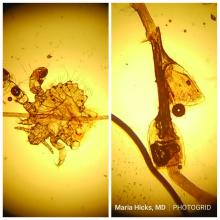 crab lice or Pediculosis pubis