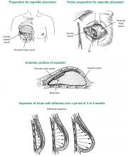 Figure 1. The process of expander placement and inflation in preparation for implant-based reconstruction.