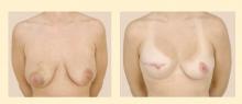 Figure 2. Preoperative (left) and post­operative (right) photos of a patient who underwent mastectomy of the right breast followed by silicone implant placement and nipple reconstruction