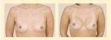 Figure 3. Preoperative (left) and postoperative (right) photos of a patient who underwent reconstruction with silicone implants after bilateral nipple-sparing mastectomy. 