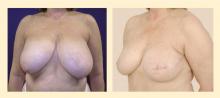 Figure 4. Preoperative (left) and postoperative (right) photos of a patient with left breast cancer who underwent mastectomy and immediate autologous reconstruction with the DIEP free flap technique.