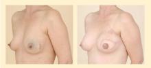 Figure 5. Preoperative (left) and postoperative (right) photos of a patient with left breast cancer who underwent mastectomy with immediate autologous reconstruction using the DIEP free flap procedure.