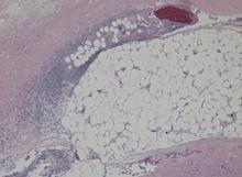 Figure 2. Necrosis of deep dermis, subcutaneous fat, and fascial tissue with polymorphonuclear cell infiltration.