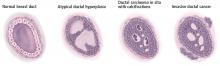 Figure 1. Histology: the morphologic progression of ductal breast cancer.