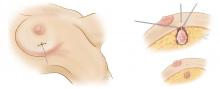 Figure 2. Needle localization for partial mastectomy (breast conservation therapy).