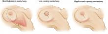 Figure 3. Incisions for three common types of mastectomy.