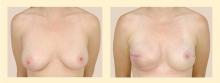 Figure 4. Photos of a patient before (left) and after (right) bilateral mastectomy and breast reconstruction using silicone implants.