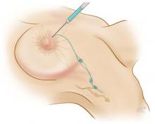 Figure 5. Sentinel lymph node biopsy involves intraoperative injection of vital blue dye and/or radionuclide near the areola, after which the axillary nodes are inspected for uptake of the dye or radionuclide to identify the sentinel node.