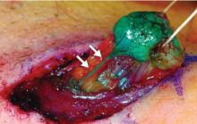 Figure 6. Removal of a sentinel lymph node after uptake of vital blue dye.