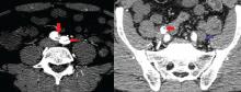 Left, computed tomography of the abdomen with intravenous contrast