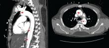 Computed tomography of the chest with intravenous contrast