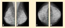 Figure 1. Normal dense digital mammogram images showing right and left mediolateral oblique views and right and left craniocaudal views.