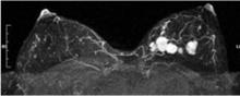 Figure 2. Contrast-enhanced breast MRI in the axial projection demonstrating multiple malignant masses in the left breast.