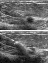 Figure 3. “Pre-fire” (top) and “post-fire” (bottom) ultrasonographic views of an 18-gauge percutaneous needle core biopsy of a suspicious breast mass.