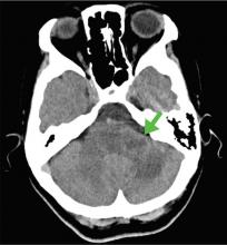 Figure 1. Computed tomography 2 months after the onset of symptoms showed a low-density lesion in the left middle cerebellar peduncle (arrow).