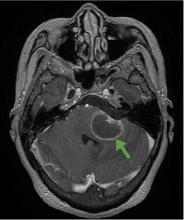 Figure 2. T2-weighted MRI with contrast revealed a cystic enhancing lesion in the left middle cerebellar peduncle (arrow).