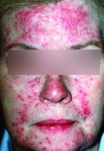 Inflammatory rosacea, presenting with papules and pustules on the forehead, cheeks, nose and chin.