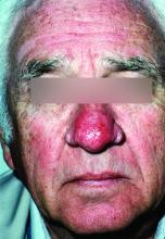 phymatous rosacea